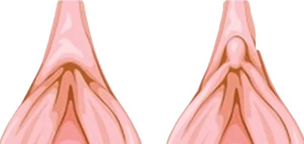 CLITORAL HOOD REDUCTION