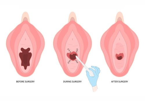 Mini-Vaginal Tightening