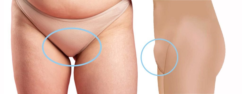 Mons Pubis Reduction