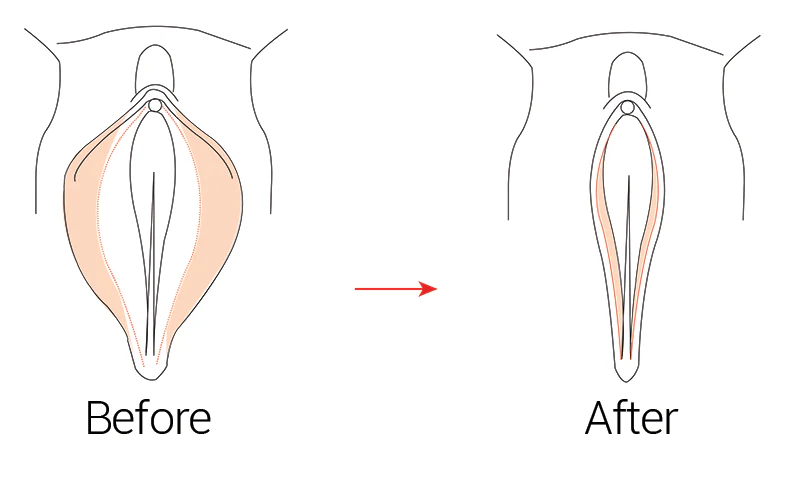 Nonsurgical Labiaplasty