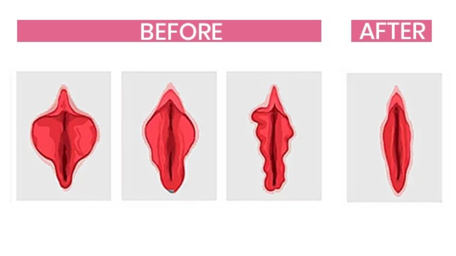 Vaginal Rejuvenation