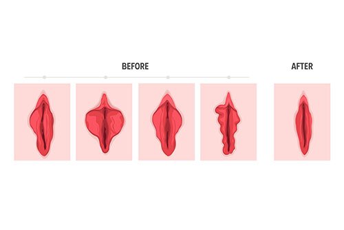 What Does Medical Evidence Say About “Vaginal Rejuvenation”