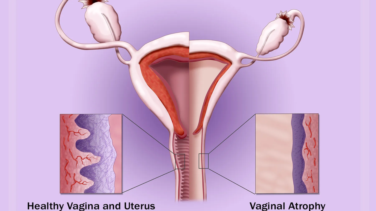 Vaginal Dryness: Causes, Symptoms, Treatment and When to See a Gynecologist