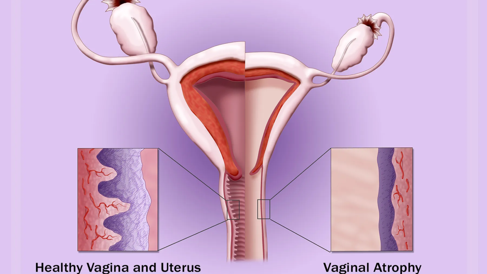 Vaginal Dryness: Causes, Symptoms, Treatment and When to See a Gynecologist