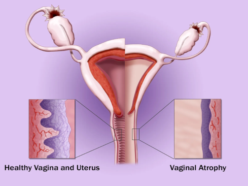 Vaginal Dryness: Causes, Symptoms, Treatment and When to See a Gynecologist