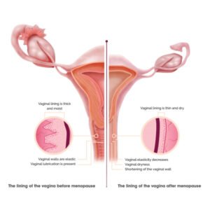 What Is Vaginal Dryness?